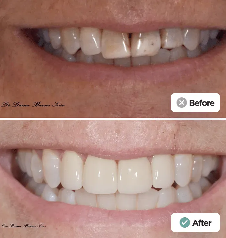 Before and after chipped front tooth repair
