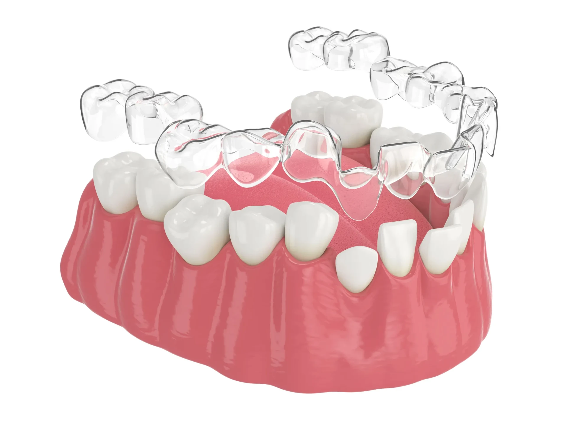 Clear aligner tray fitting onto lower teeth — clear aligners at VIP Dental Clinic Miranda