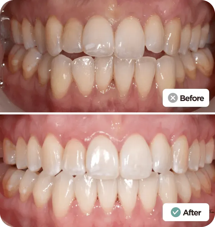 Before and after chipped tooth cosmetic repair