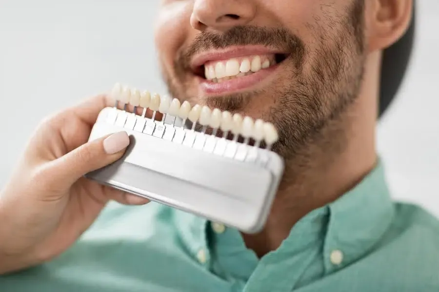 Composite veneers shade selection for a male patient