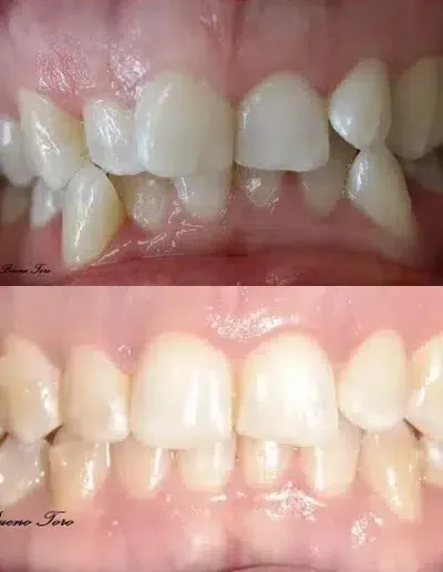 Before and after cosmetic dentistry alignment result
