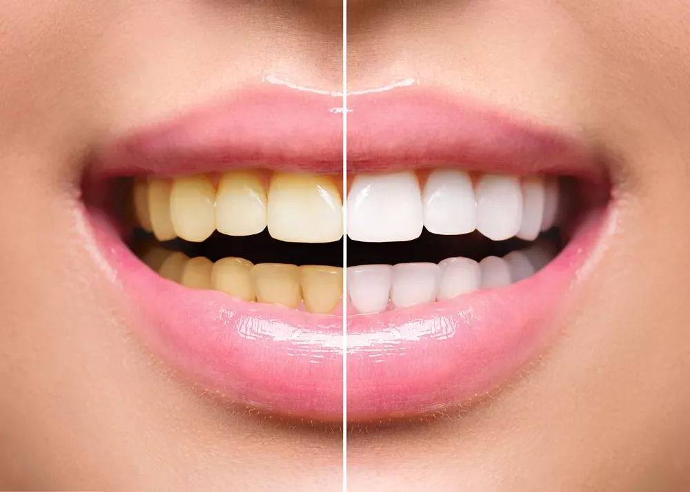 Before and after professional teeth whitening result