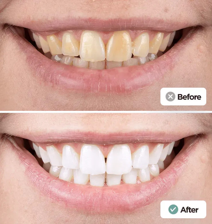 Before and after teeth whitening emergency restoration