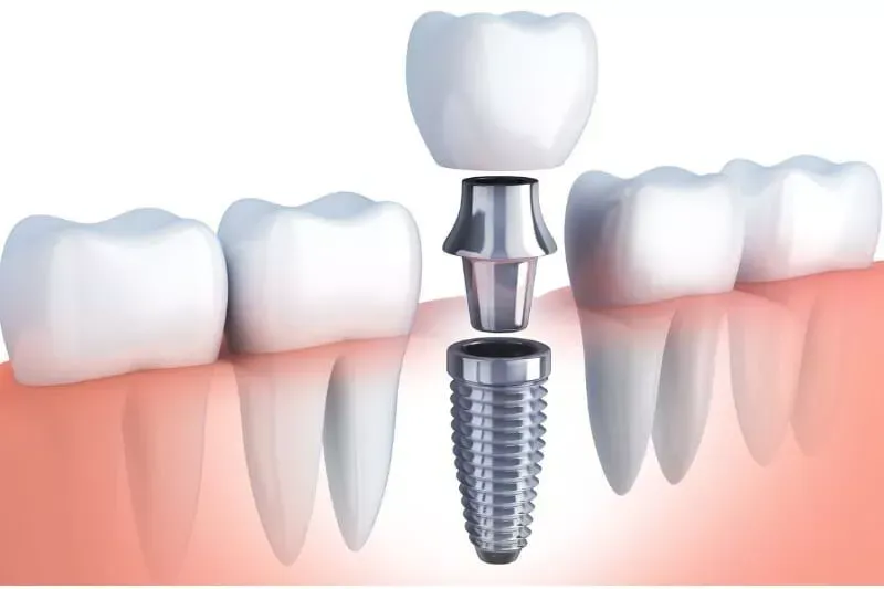 Dental implant illustration — replacing a knocked-out tooth