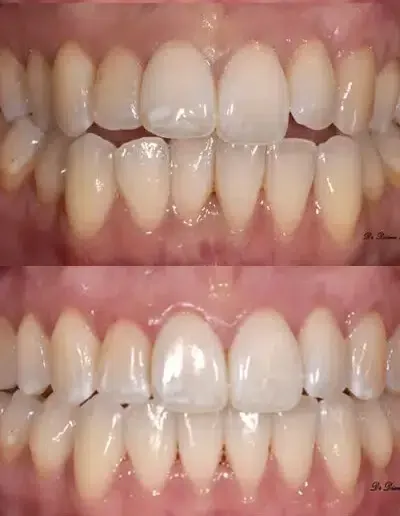 Clear aligners before and after — front smile alignment