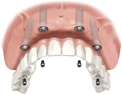 All-on-4 dental implant illustration showing four implants supporting a full-arch bridge