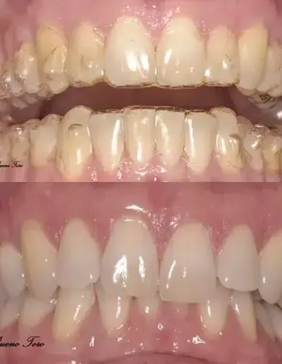 Clear aligners before and after — full smile transformation