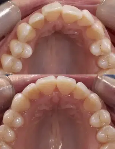 Clear aligners before and after — upper arch alignment