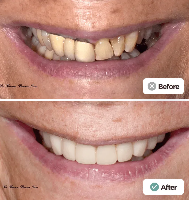 Before and after full smile restoration with crowns