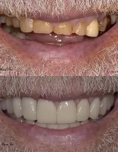 Before and after full smile restoration with crowns and veneers