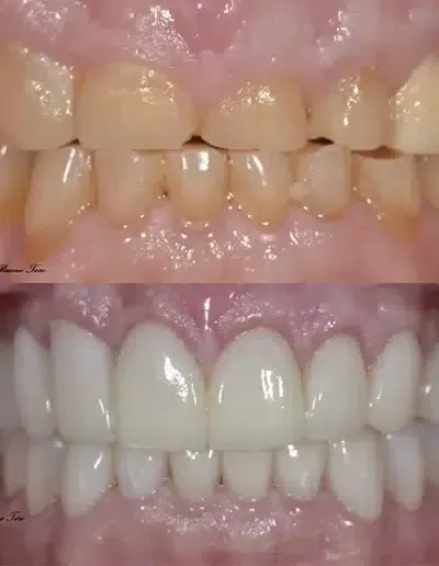 Before and after porcelain veneers smile makeover