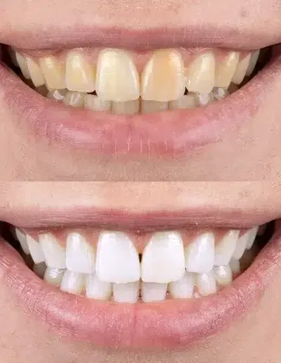Before and after teeth whitening result at VIP Dental Clinic Miranda