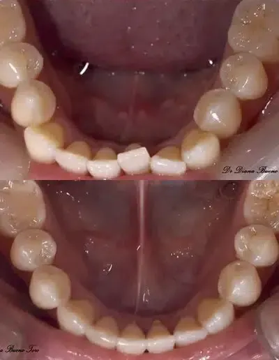 Clear aligners before and after — lower arch crowding corrected